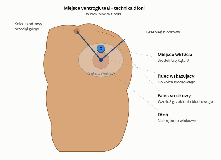 zastrzyk-testosteronu-w-biodro-miejsca-wklucia